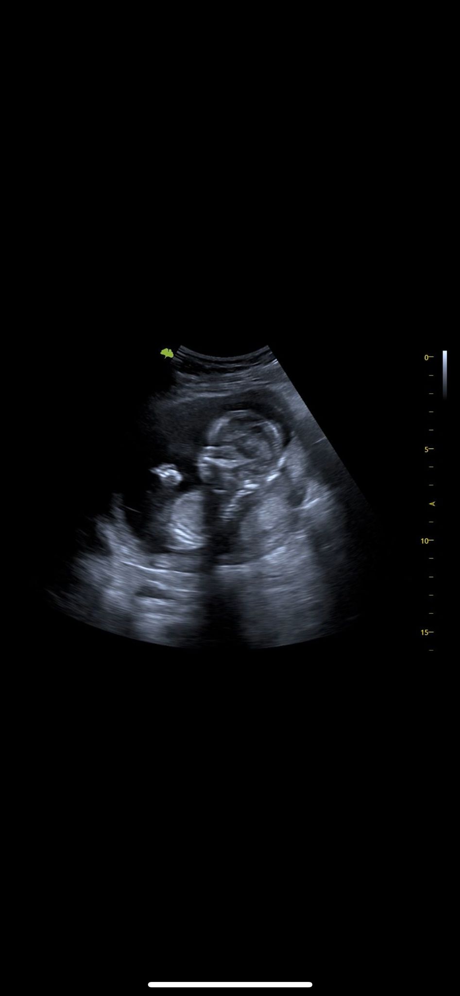 2D ultrasound echo