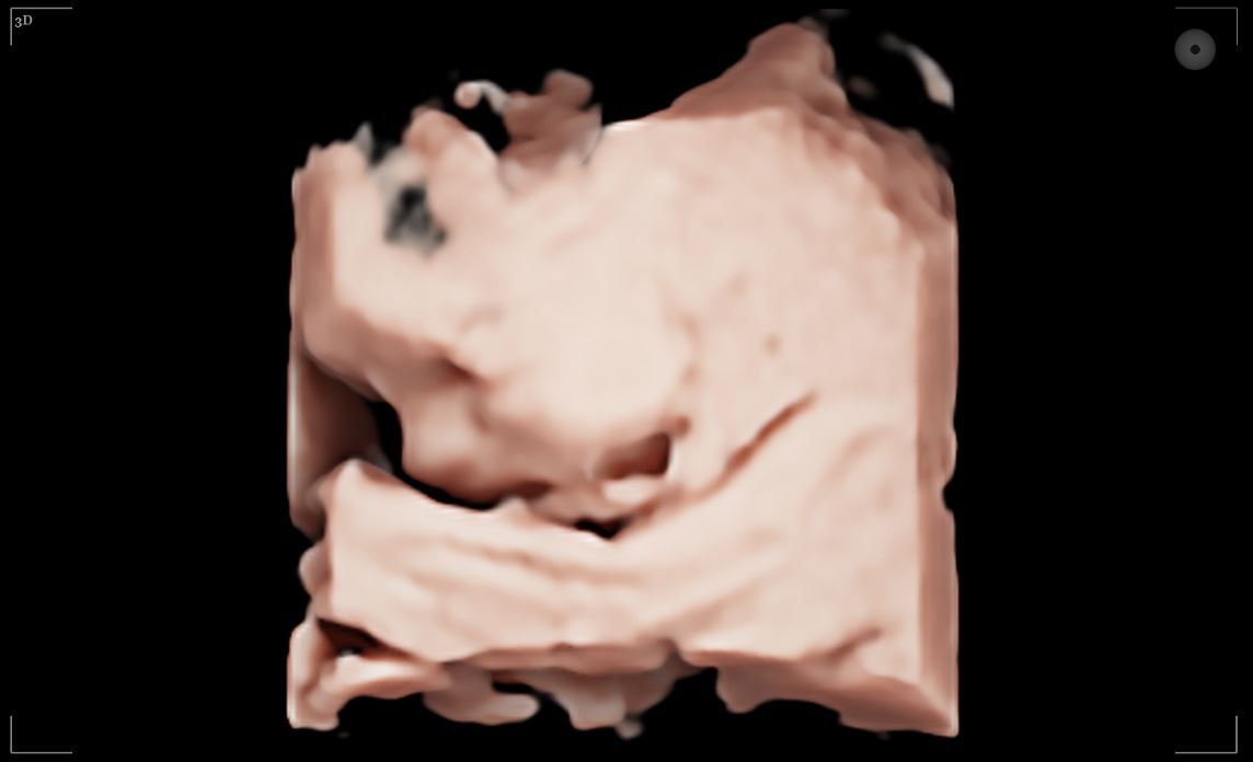 3D echo beeld van baby